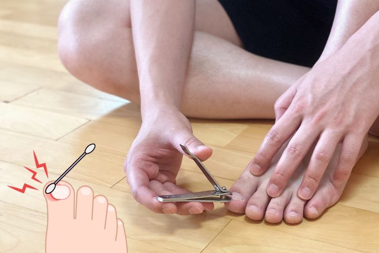 Remède de grand-mère pour soulager un ongle incarné